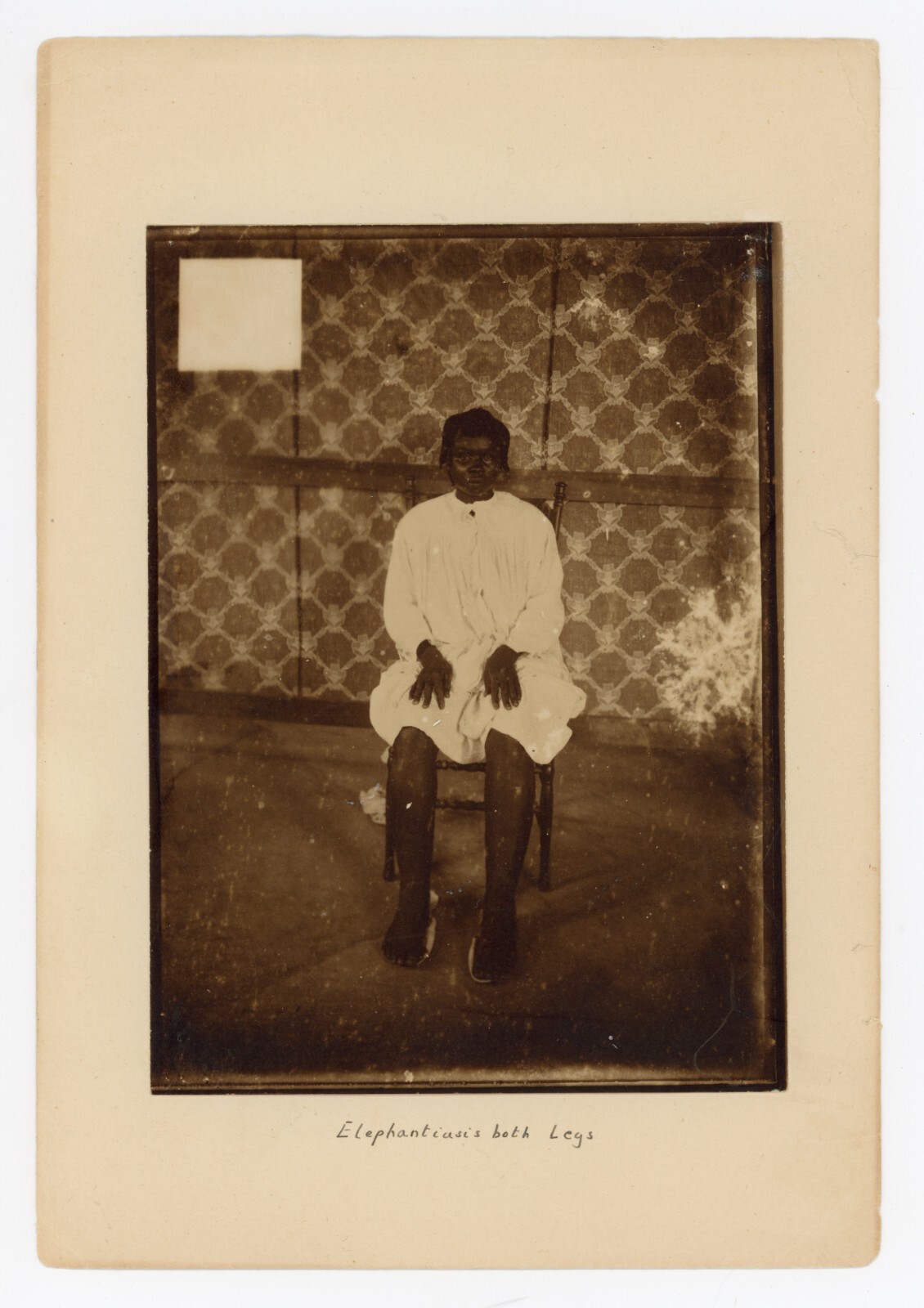 Medical Photo African Girl Elephantiasis 1900 Portrait Vintage Original